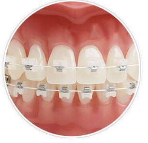 CrystalClear Sapphire Brackets