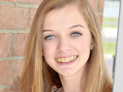 Fun Braces Ligature Ties