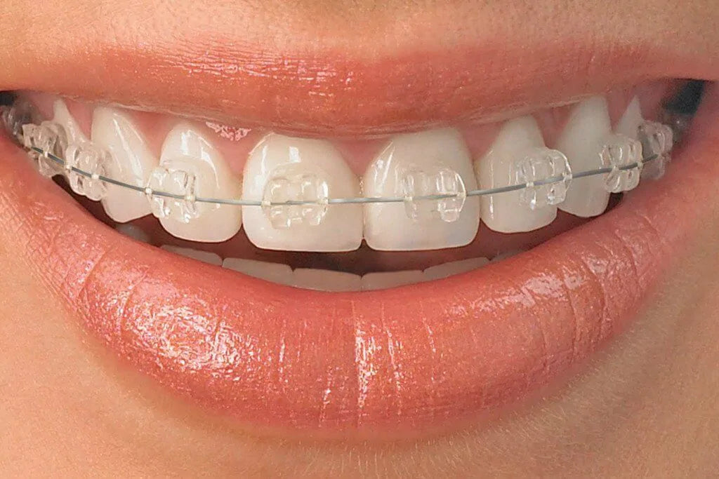 CrystalClear Sapphire Brackets